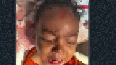 rsud-karangasem-sigap-tangani-balita-korban-gigitan-anjing-liar-di-abang