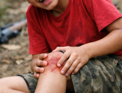 Tragis! Bocah 12 Tahun di Karangasem Tertembak Peluru Nyasar Saat Berburu Tupai, Peluru Bersarang di Tulang