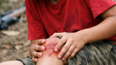 tragis-bocah-12-tahun-di-karangasem-tertembak-peluru-nyasar-saat-berburu-tupai-peluru-bersarang-di-tulang