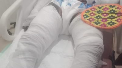 Luka Bakar Tak Terampuni, Gede Selamet Akhirnya Berpulang